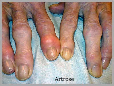 artrose Amstelveen