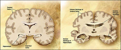 Alzheimer Amstelveen